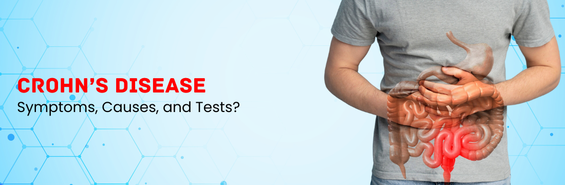 Crohn’s Disease: What are the Symptoms, Causes, and Tests?